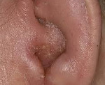 Как снять заложенность уха при аллергии thumbnail