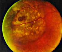 Гемангиома хориоидеи глаза лечение thumbnail