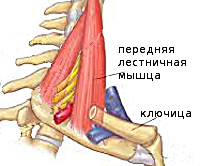 Шейный остеохондроз синдром передней лестничной мышцы thumbnail
