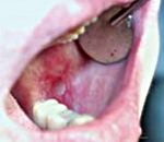 Заболевания слизистой оболочки полости рта лишай thumbnail