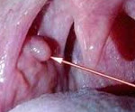 Плоскоклеточная папиллома слизистой рта thumbnail