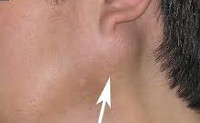 Отек верхней губы опухоли слюнной железы thumbnail