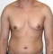 Операция по уменьшению груди при гинекомастии