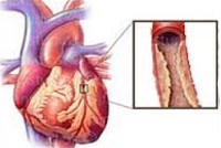 Атеросклеротический кардиосклероз