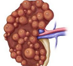 Гломеруоцитоз почек гипопластического типа