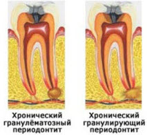 Гранулематозный периодонтит