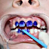 Фторирование зубов у детей