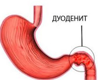 Дуоденит