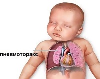 Пневмоторакс у новорожденных