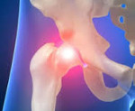 Синовит тазобедренного сустава : симптомы и лечение синовита тазобедренного сустава
