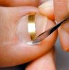 Коррекция вросшего ногтя полускобами Goldstadt