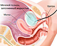 Процедура Цистоскопия у женщин