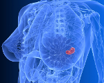 Трижды негативный рак молочной железы