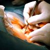 Лазерная хирургия при трофических язвах