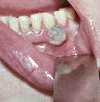 Удаление новообразования полости рта