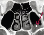 Инородное тело верхнечелюстной пазухи
