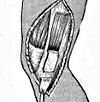 Операция при разрыве связок коленного сустава