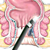 Инфракрасная фотокоагуляция геморроидальных узлов