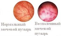 Цистит у мужчин