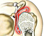 Синовит плечевого сустава