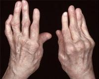 Артроз кистей и пальцев рук