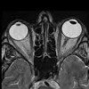 МРТ орбит и зрительных нервов