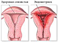 Симптомы эндометриоза у женщин