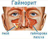 Доклад по теме Гайморит