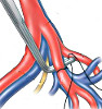 Перевязка маточных артерий