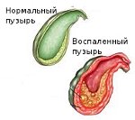 Хронический бескаменный холецистит