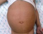 Цирроз печени у детей Цирроз печени у детей