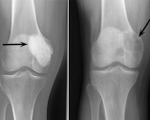Гигантоклеточная опухоль кости