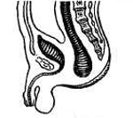 Атрезия заднего прохода и прямой кишки