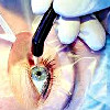 Лазерная коррекция близорукости с астигматизмом (LASIK)