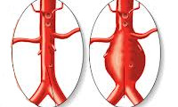 Аневризма грудной аорты – симптомы, причины, опасность последствий заболевания, как часто бывает разрыв, лечение