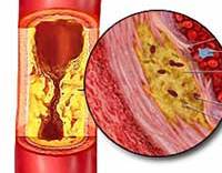 Атеросклероз брюшной аорты
