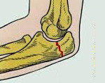 Перелом локтевого отростка