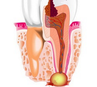 Заболевания тканей периапикальной части зуба