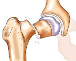 Перелом шейки бедра у пожилых
