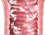 Что такое заболевание молочница у женщин
