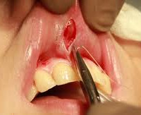 Процедура Пластика уздечки верхней губы