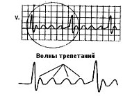 Верапамил При Трепетании Предсердий