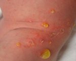 Кожные заболевания новорожденных Кожные заболевания новорожденных