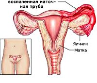 Сальпингит