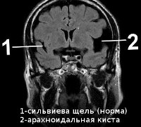 Киста головного мозга