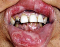 Сифилис полости рта 
