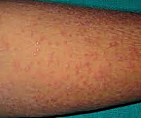 Лихеноидный туберкулез кожи