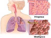 Реферат: Альвеолит фиброзирующий идиопатический