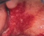 Эритроплакия полости рта 