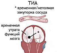 Ишемическая атака сосудов головного мозга что это такое thumbnail